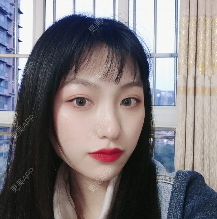 更美 - 更美用户akk91yDUSK的玻尿酸唇部经验 | 玻尿酸唇部