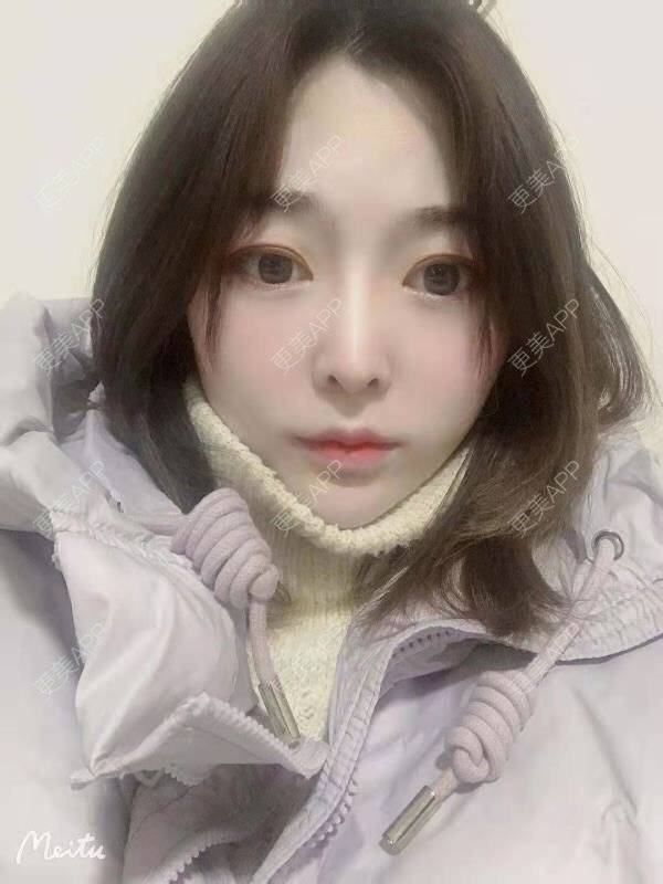 更美 - 更美用户aoql3tHMzk的隆鼻经验 | 自体脂肪全面部填充 | 自体脂肪填充泪沟 | 自体脂肪垫下巴 | 自体脂肪丰额头 | 自体脂肪填充法令纹 | 隆鼻 | 鼻部多项 | 肋软骨隆鼻 | 鼻翼缩小 | 鼻中隔软骨隆鼻 | 鼻小柱延长 | 耳软骨隆鼻