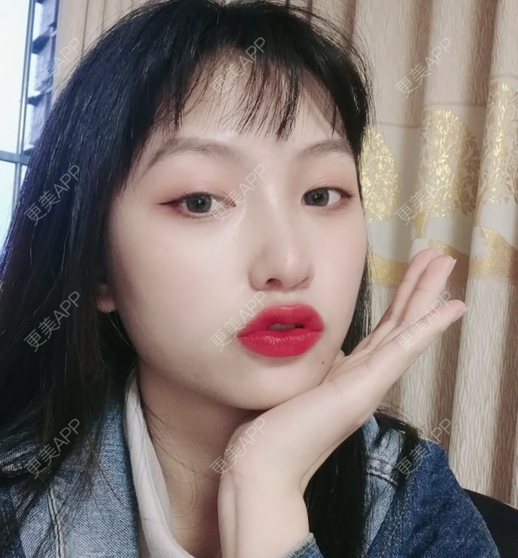 更美 - 更美用户akk91yDUSK的玻尿酸唇部经验 | 玻尿酸唇部