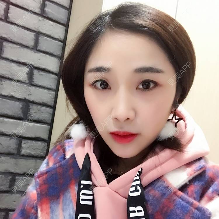 更美 - honey堤的光子嫩肤经验 | 北京 | 光子嫩肤