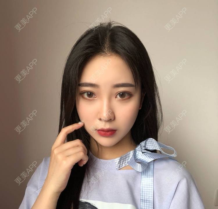 更美 - 迷乱花海拐的微针水光经验 | 德州 | 微针水光