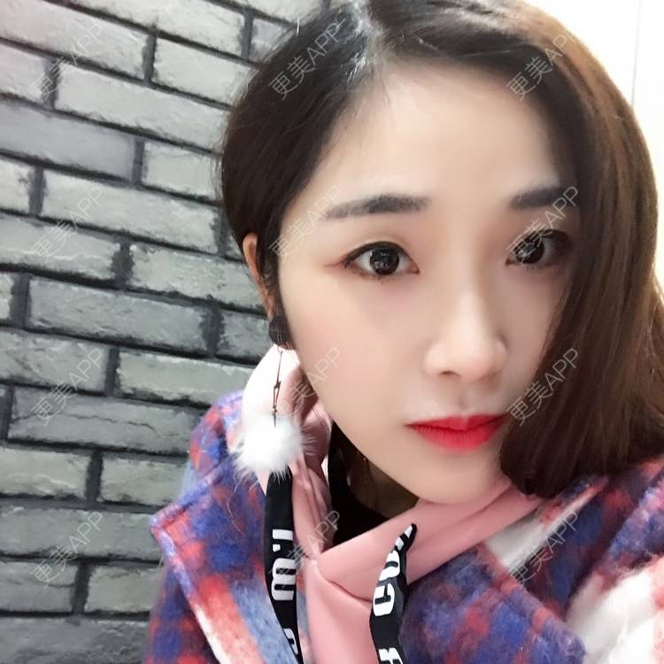 更美 - honey堤的光子嫩肤经验 | 北京 | 光子嫩肤
