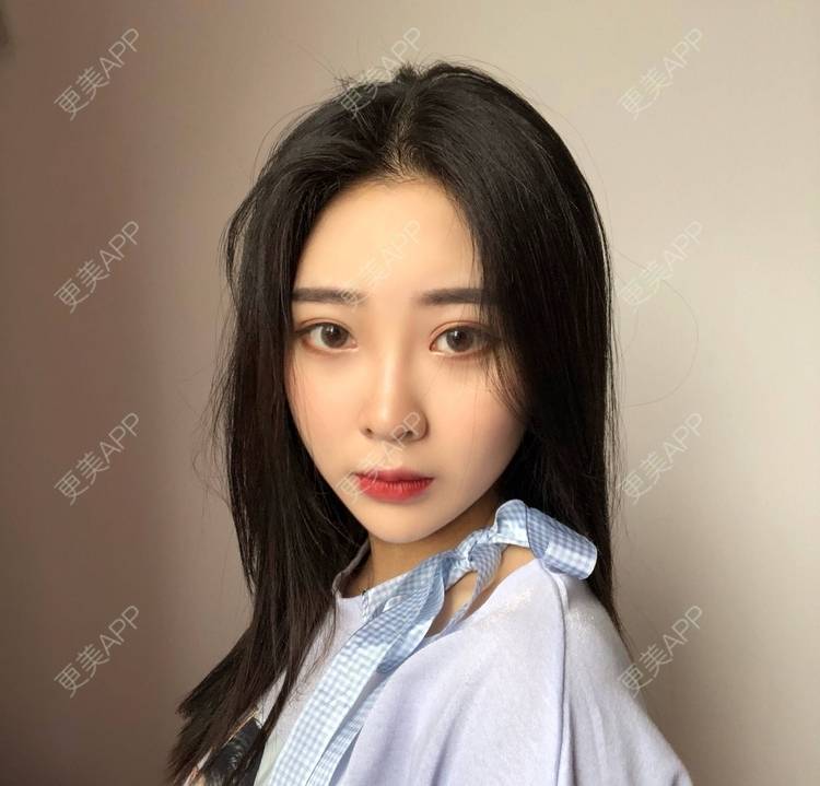 更美 - 迷乱花海拐的微针水光经验 | 德州 | 微针水光
