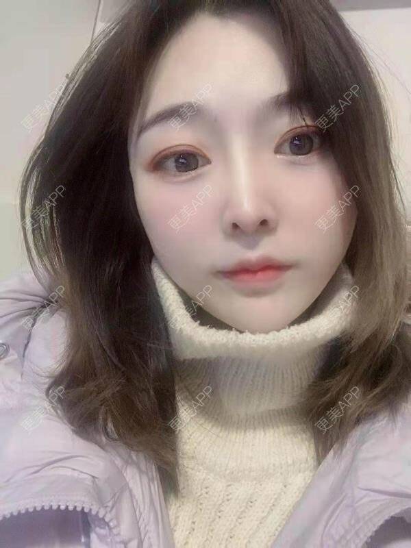 更美 - 更美用户aoql3tHMzk的自体脂肪丰苹果肌经验 | 自体脂肪丰苹果肌 | 自体脂肪填充面部细纹 | 自体脂肪全面部填充 | 自体脂肪丰额头 | 自体脂肪丰面颊 | 自体脂肪丰太阳穴