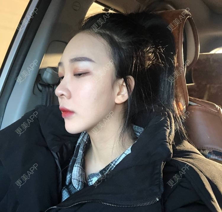更美 - 迷乱花海拐的微针水光经验 | 德州 | 微针水光