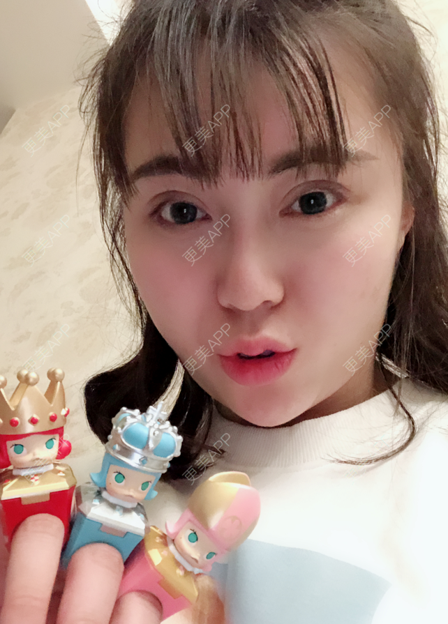更美 - 更美用户bUbNBmSQgL的M唇成形经验 | M唇成形 | 视频日记