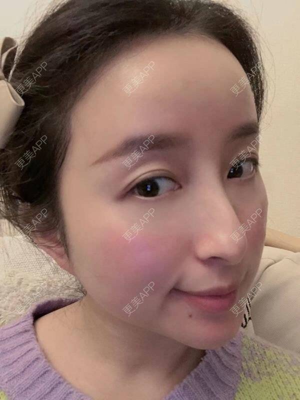 更美 - 克卜勒伤的祛眼袋经验 | 眶隔脂肪释放 | 内眦赘皮矫正 | 内切去眼袋 | 综合去眼袋 | 眼综合修复 | 祛眼袋 | 外切去眼袋 | 激光去眼袋 | 射频去眼袋