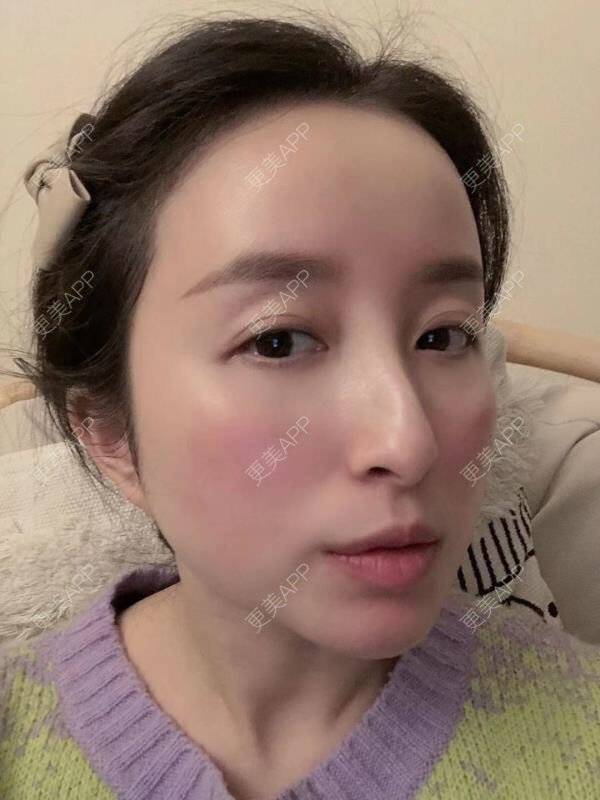 更美 - 克卜勒伤的祛眼袋经验 | 眶隔脂肪释放 | 内眦赘皮矫正 | 内切去眼袋 | 综合去眼袋 | 眼综合修复 | 祛眼袋 | 外切去眼袋 | 激光去眼袋 | 射频去眼袋