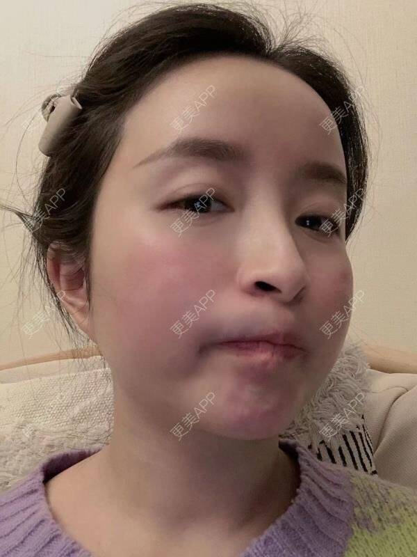 更美 - 克卜勒伤的祛眼袋经验 | 眶隔脂肪释放 | 内眦赘皮矫正 | 内切去眼袋 | 综合去眼袋 | 眼综合修复 | 祛眼袋 | 外切去眼袋 | 激光去眼袋 | 射频去眼袋