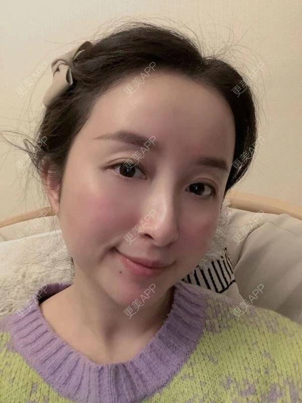 更美 - 克卜勒伤的祛眼袋经验 | 眶隔脂肪释放 | 内眦赘皮矫正 | 内切去眼袋 | 综合去眼袋 | 眼综合修复 | 祛眼袋 | 外切去眼袋 | 激光去眼袋 | 射频去眼袋