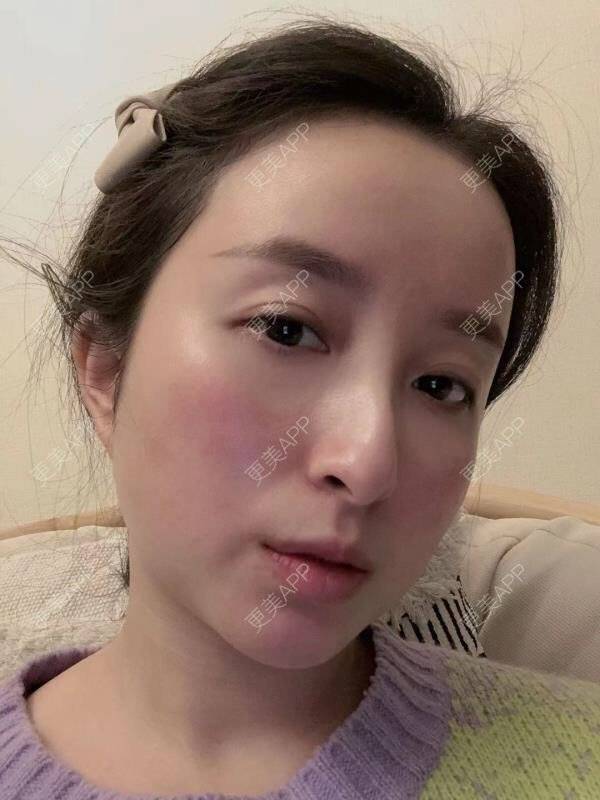 更美 - 克卜勒伤的祛眼袋经验 | 眶隔脂肪释放 | 内眦赘皮矫正 | 内切去眼袋 | 综合去眼袋 | 眼综合修复 | 祛眼袋 | 外切去眼袋 | 激光去眼袋 | 射频去眼袋