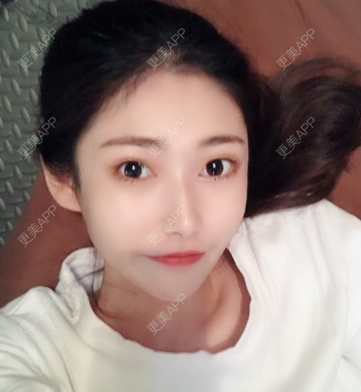 更美 - 更美用户imX6wtIlnI的玻尿酸下巴经验 | 玻尿酸下巴