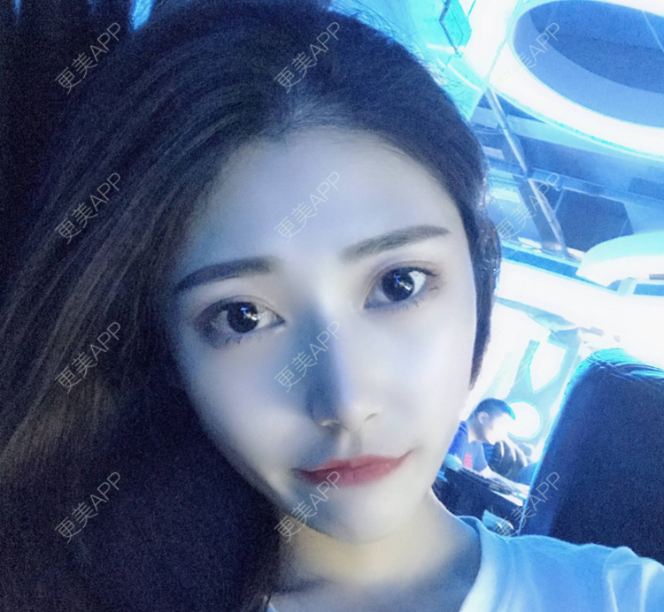 更美 - 更美用户imX6wtIlnI的玻尿酸下巴经验 | 玻尿酸下巴