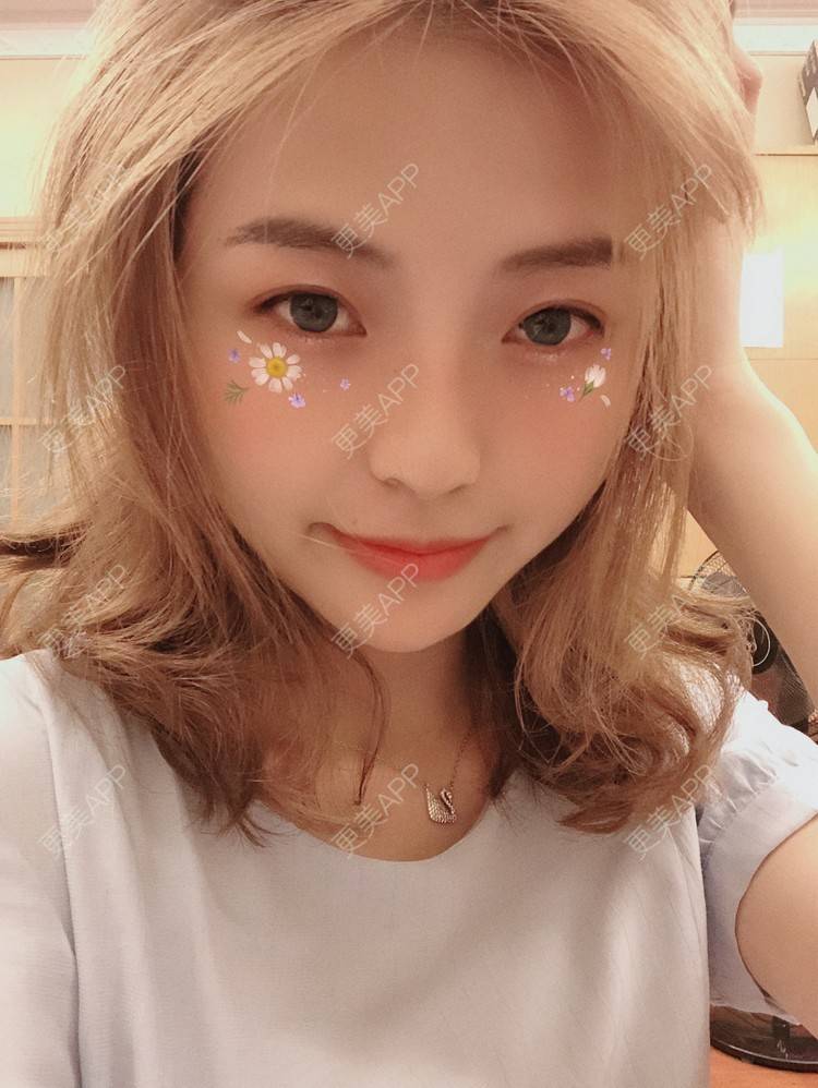 更美 - 原来就是你们的耳软骨隆鼻经验 | 耳软骨隆鼻 | 广州 | 视频日记
