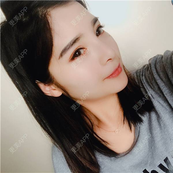 更美 - 更美用户AWHhEUXo17的硅胶垫下巴经验 | 视频日记 | 硅胶垫下巴 | 重庆