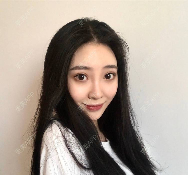 更美 - 迷乱花海拐的微针水光经验 | 德州 | 微针水光