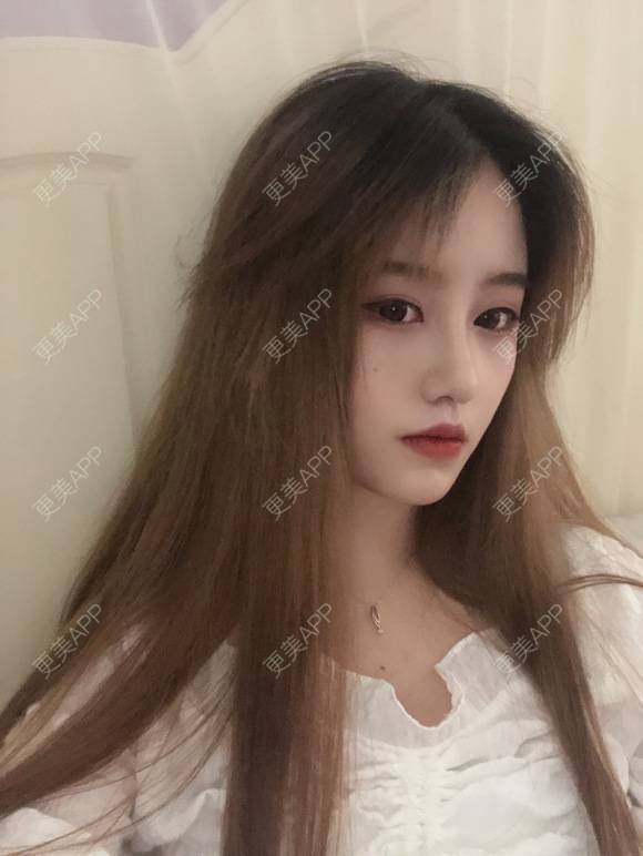 更美 - 变美仙女小仙的膨体隆鼻经验 | 膨体隆鼻