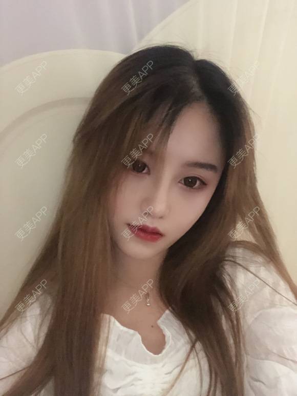 更美 - 变美仙女小仙的膨体隆鼻经验 | 膨体隆鼻