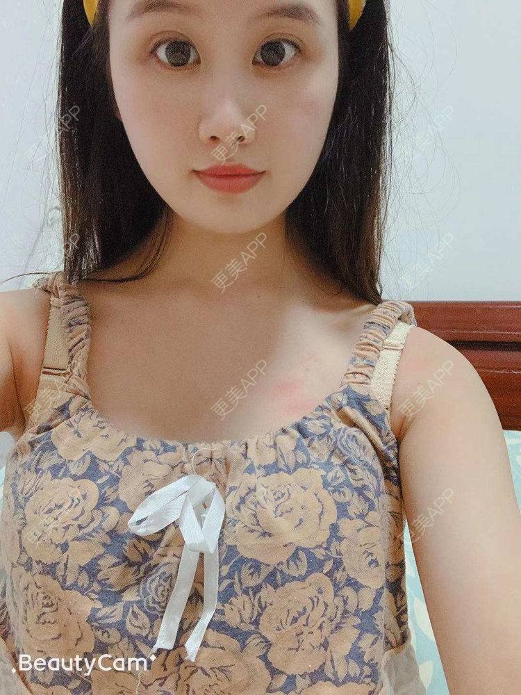 更美 - 橘子洲的汽水的假体隆胸经验 | 广州 | 视频日记 | 假体隆胸