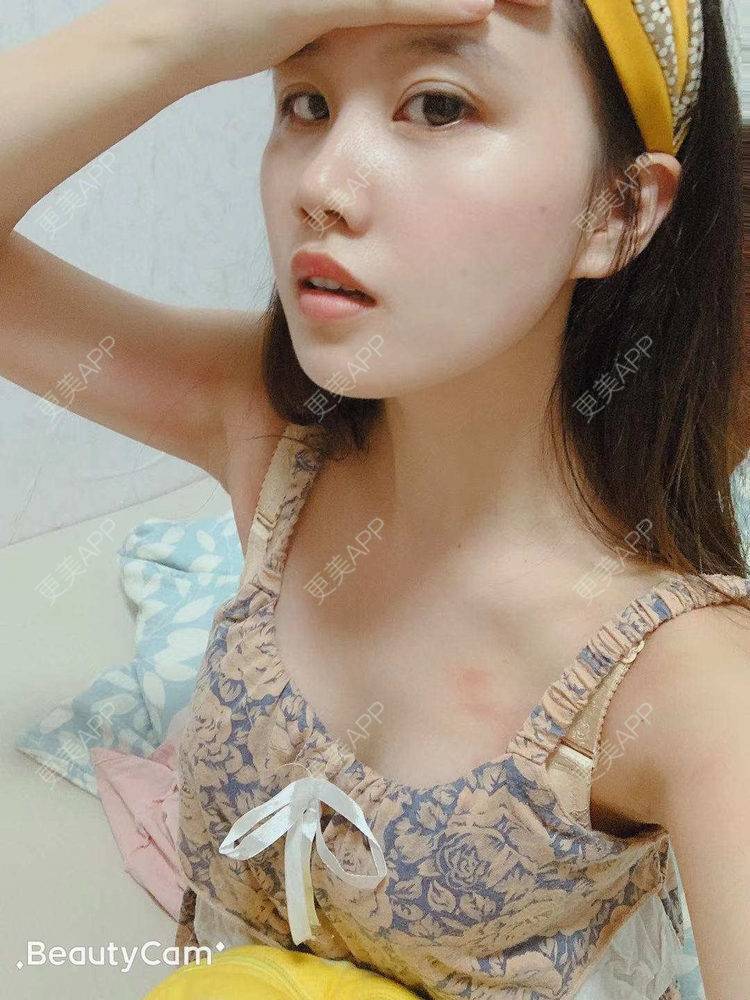 更美 - 橘子洲的汽水的假体隆胸经验 | 广州 | 视频日记 | 假体隆胸