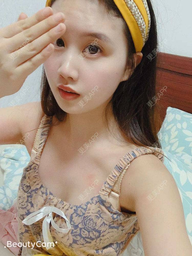 更美 - 橘子洲的汽水的假体隆胸经验 | 广州 | 视频日记 | 假体隆胸