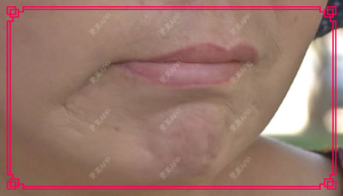 更美 - 更美用户TibwbHsHND的全脸整形套餐经验 | 全脸整形套餐