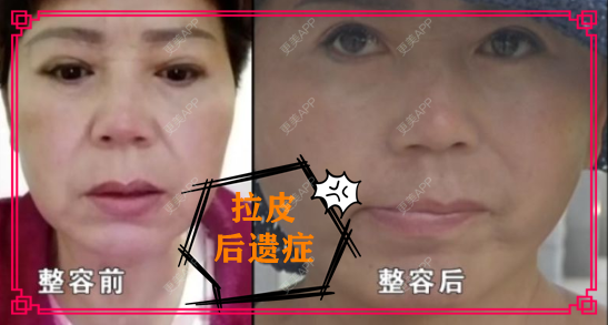 更美 - 更美用户TibwbHsHND的全脸整形套餐经验 | 全脸整形套餐