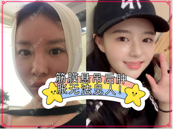 更美 - 更美用户TibwbHsHND的全脸整形套餐经验 | 全脸整形套餐