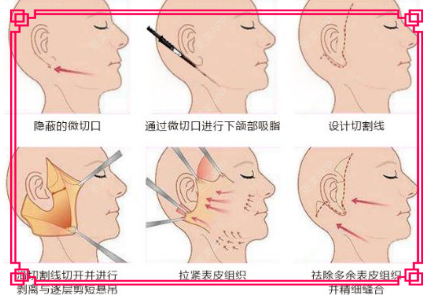 更美 - 更美用户TibwbHsHND的全脸整形套餐经验 | 全脸整形套餐