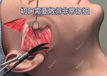 更美 - 更美用户TibwbHsHND的全脸整形套餐经验 | 全脸整形套餐