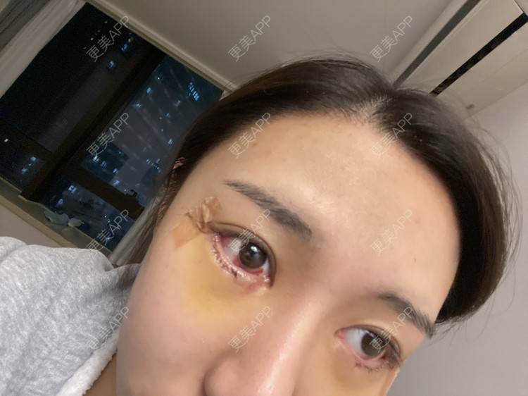 更美 - 戴嘉莉的眼部多项经验 | 深圳 | 眼部多项