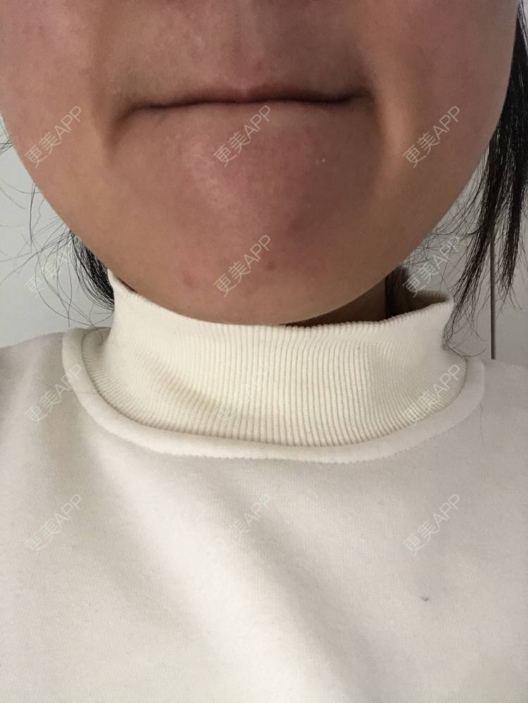 更美 - 草莓蛋糕小泡泡的水光项目经验 | 水光项目 | 成都 | 菲欧曼