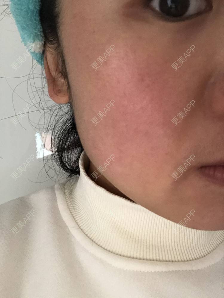 更美 - 草莓蛋糕小泡泡的水光项目经验 | 水光项目 | 成都 | 菲欧曼