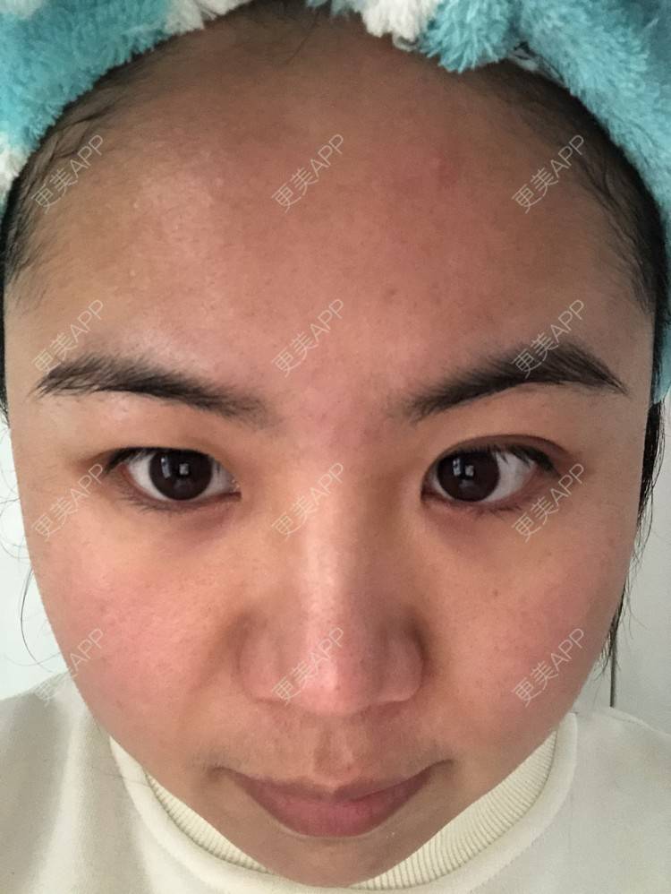 更美 - 草莓蛋糕小泡泡的水光项目经验 | 水光项目 | 成都 | 菲欧曼