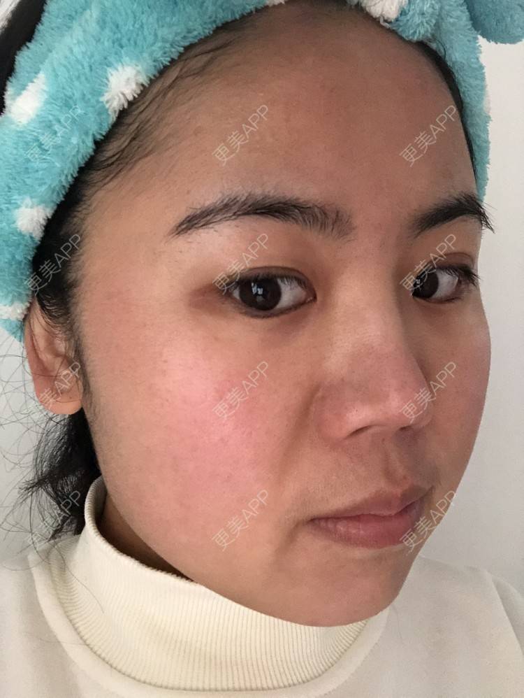 更美 - 草莓蛋糕小泡泡的水光项目经验 | 水光项目 | 成都 | 菲欧曼