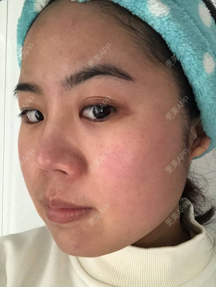 更美 - 草莓蛋糕小泡泡的水光项目经验 | 水光项目 | 成都 | 菲欧曼