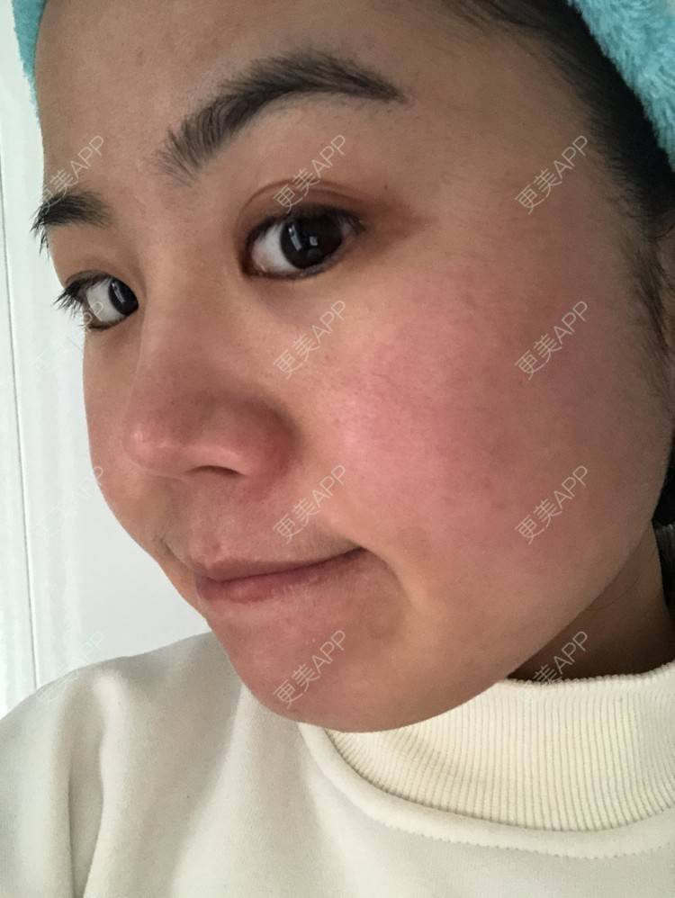 更美 - 草莓蛋糕小泡泡的水光项目经验 | 水光项目 | 成都 | 菲欧曼