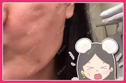 更美 - 更美用户Kagp03q2ym的埋线除皱经验 | 埋线除皱