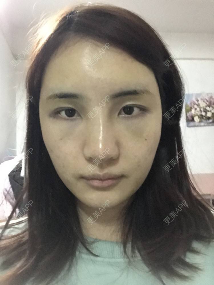 更美 - •你的小可爱•的自体脂肪垫下巴经验 | 自体脂肪垫下巴 | 自体脂肪丰太阳穴 | 深圳 | 自体脂肪垫鼻基底 | 玻尿酸溶解酶