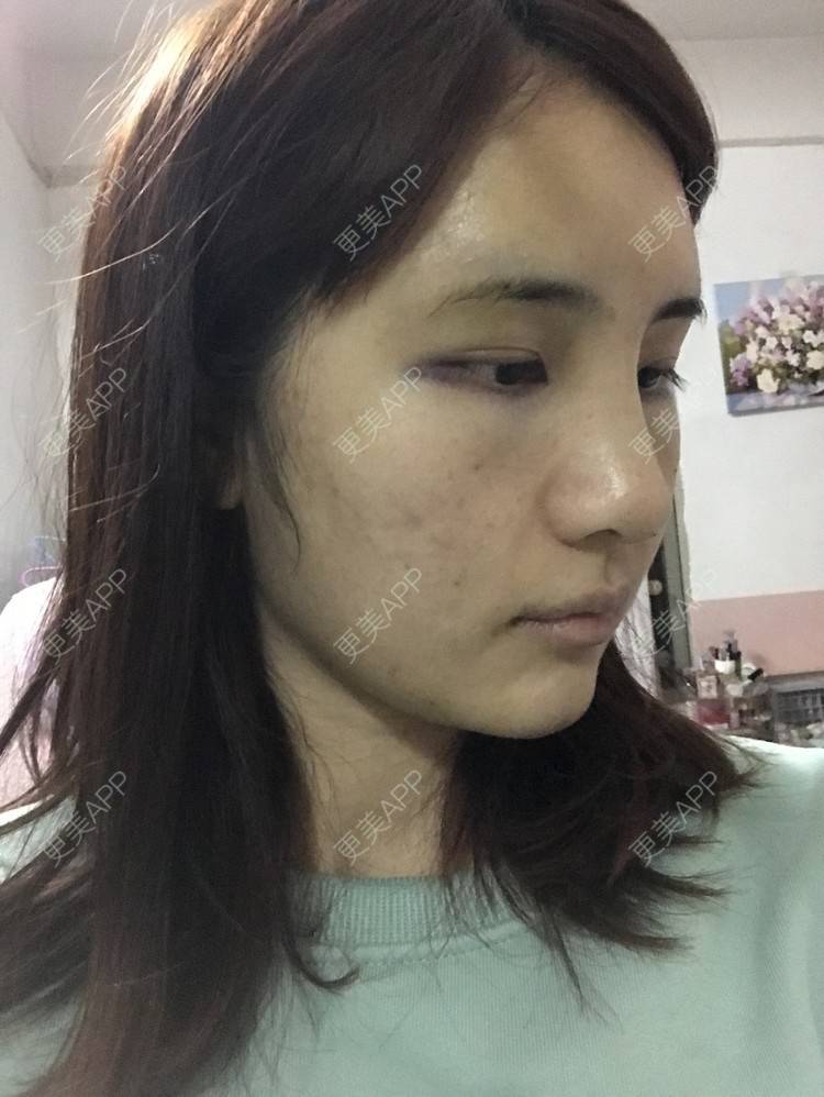更美 - •你的小可爱•的自体脂肪垫下巴经验 | 自体脂肪垫下巴 | 自体脂肪丰太阳穴 | 深圳 | 自体脂肪垫鼻基底 | 玻尿酸溶解酶