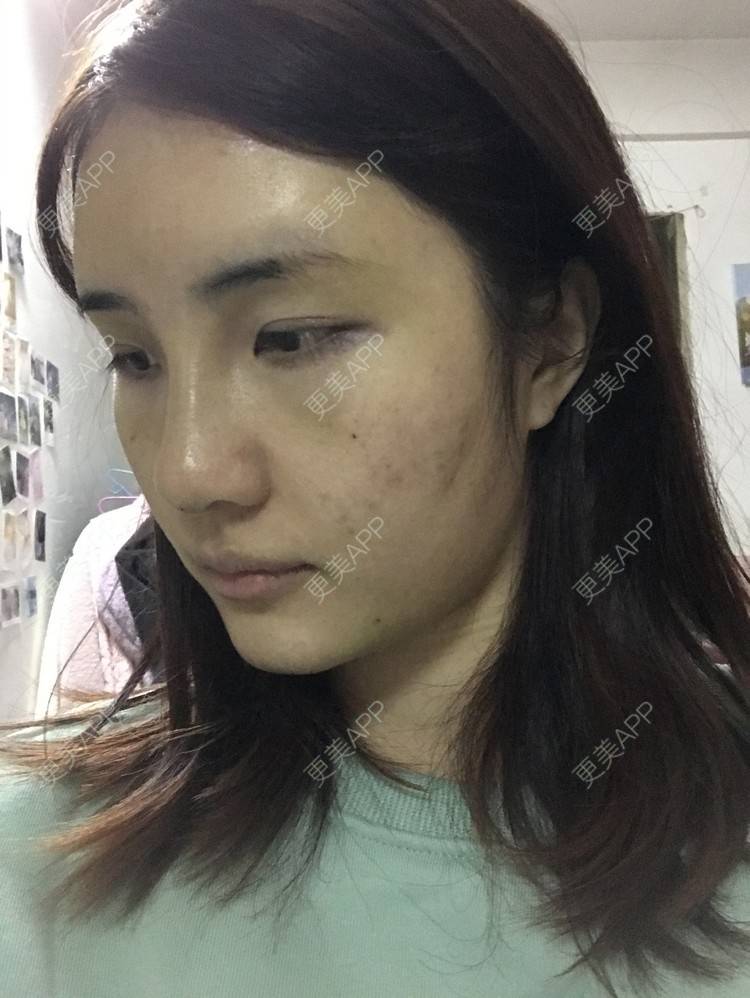 更美 - •你的小可爱•的自体脂肪垫下巴经验 | 自体脂肪垫下巴 | 自体脂肪丰太阳穴 | 深圳 | 自体脂肪垫鼻基底 | 玻尿酸溶解酶