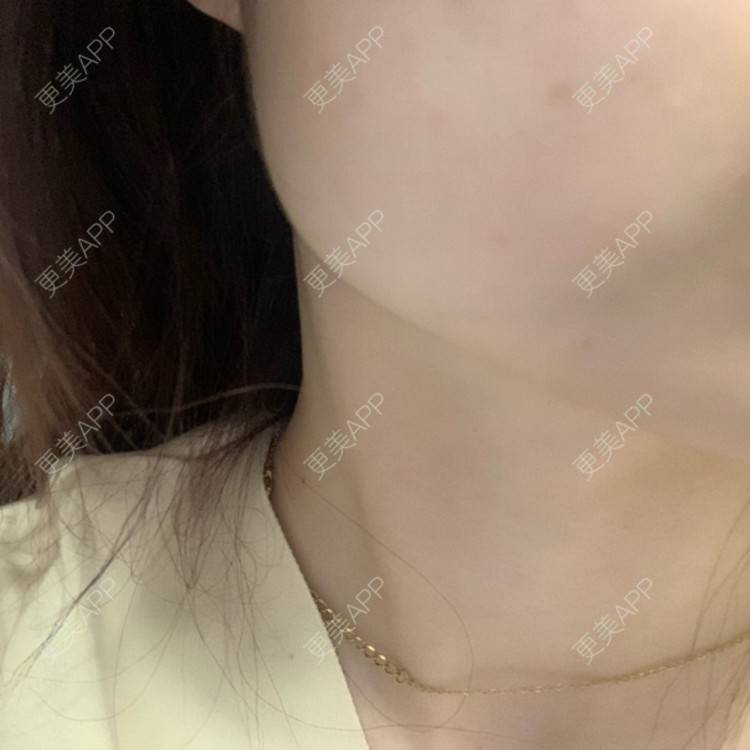 更美 - 更美用户l5RE8rSRcc的除皱瘦脸经验 | 除皱瘦脸 | 北京 | 更美研究所