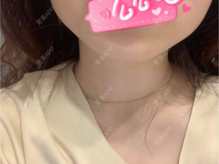 更美 - 更美用户l5RE8rSRcc的除皱瘦脸经验 | 除皱瘦脸 | 北京 | 更美研究所