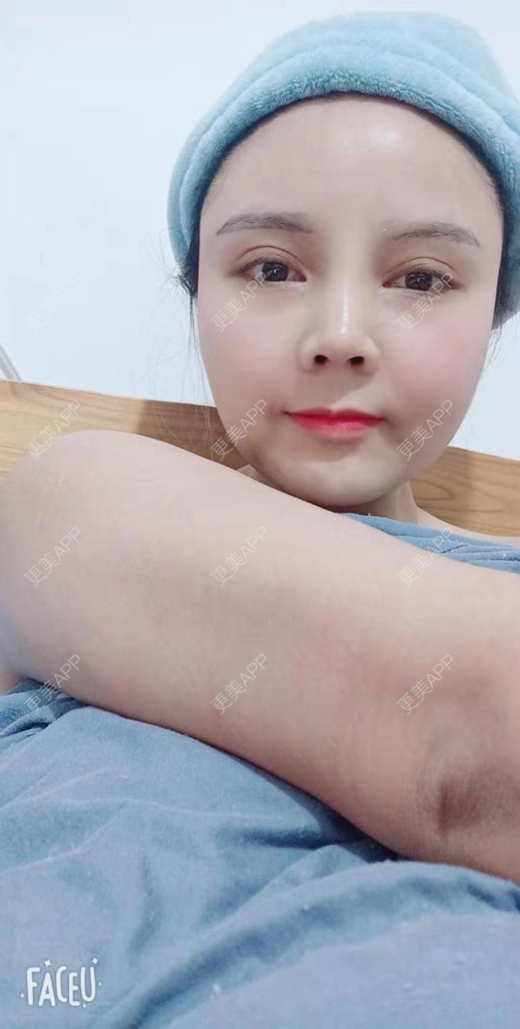 更美 - 更美用户PVvylmTjJA的手臂吸脂经验 | 手臂吸脂 | 长沙