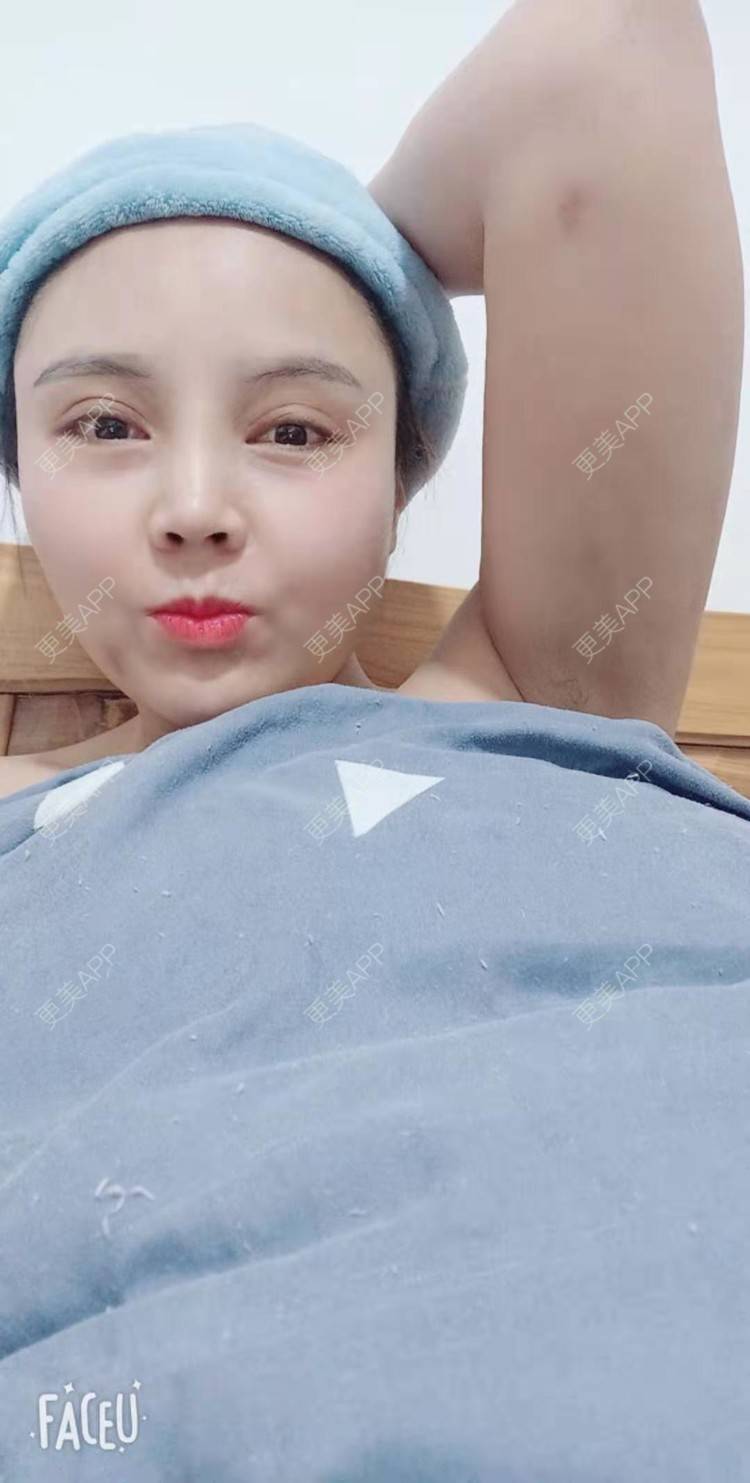 更美 - 更美用户PVvylmTjJA的手臂吸脂经验 | 手臂吸脂 | 长沙