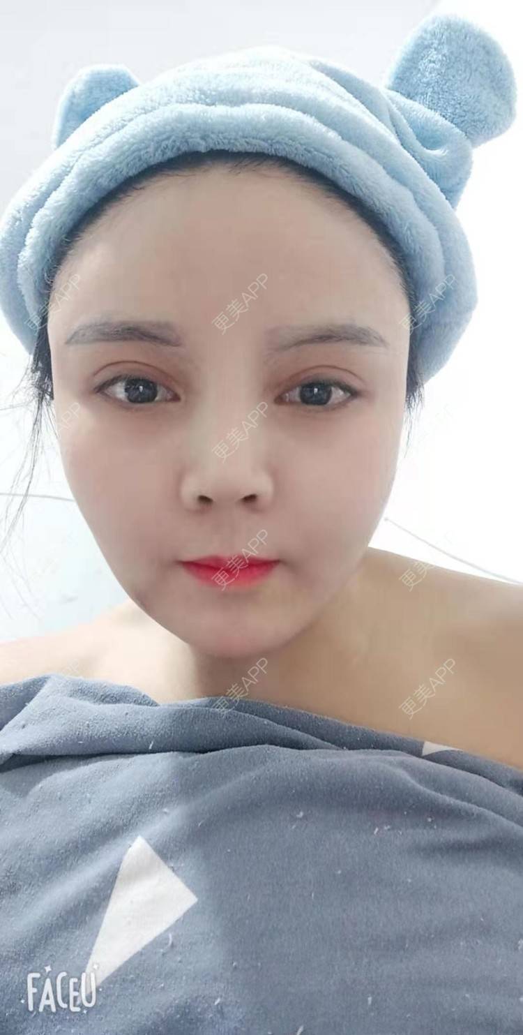 更美 - 更美用户PVvylmTjJA的手臂吸脂经验 | 手臂吸脂 | 长沙
