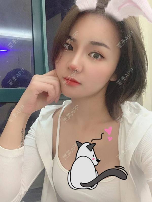 更美 - 更美用户3dxq4evfQ4的手臂吸脂经验 | 手臂吸脂