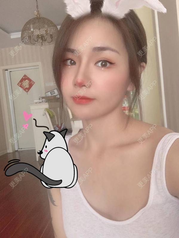 更美 - 更美用户3dxq4evfQ4的手臂吸脂经验 | 手臂吸脂