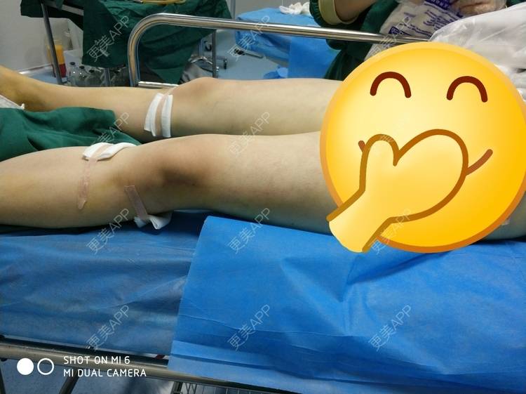 更美 - 更美用户yE8KtSeMLF的小腿吸脂经验 | 小腿吸脂 | 长沙