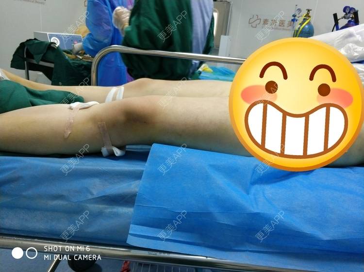 更美 - 更美用户yE8KtSeMLF的小腿吸脂经验 | 小腿吸脂 | 长沙